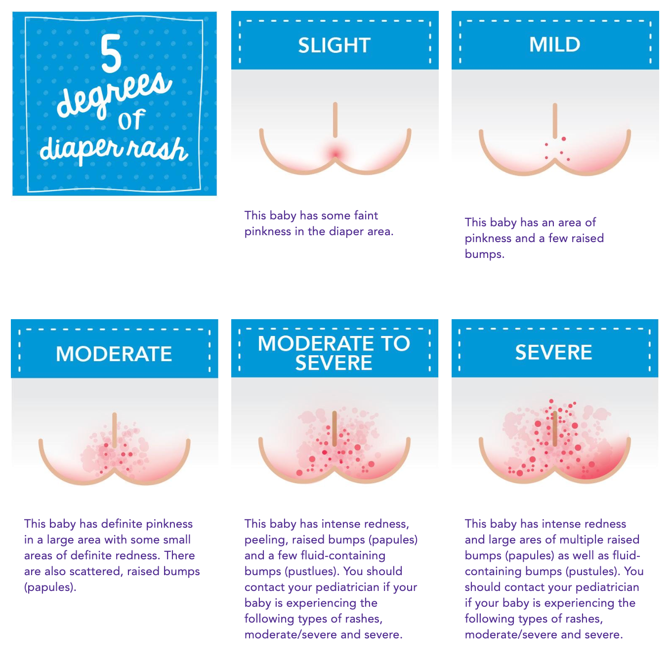 Staph Diaper Rash  : Conquering the Itch