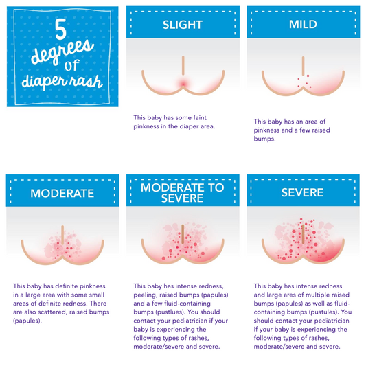 Tips on Preventing Diaper Rash